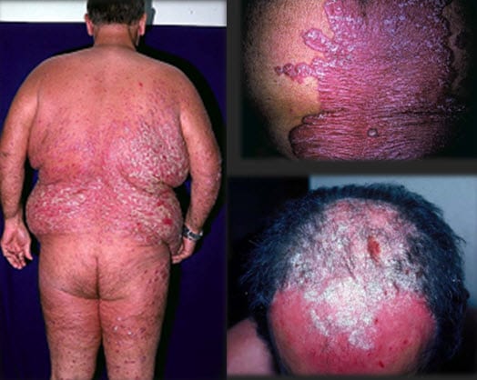 Psoriasis Case Challenge: Can You Effectively Manage the Psoriasis Case Challenge: Can You Effectively Manage the