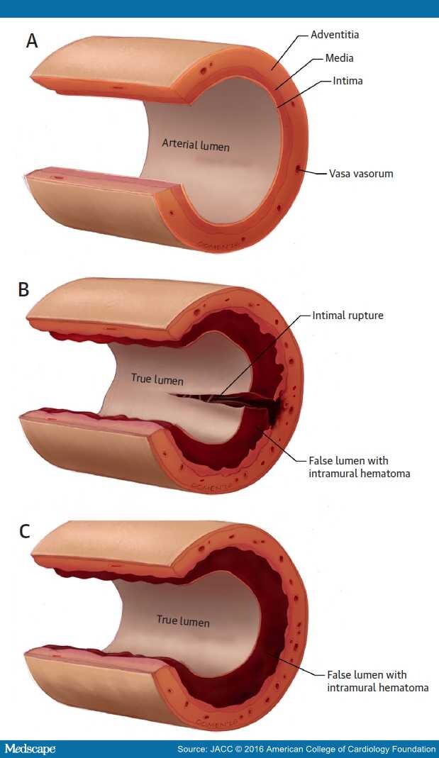 spontaneous-coronary-artery-dissection-scad-cardionerds