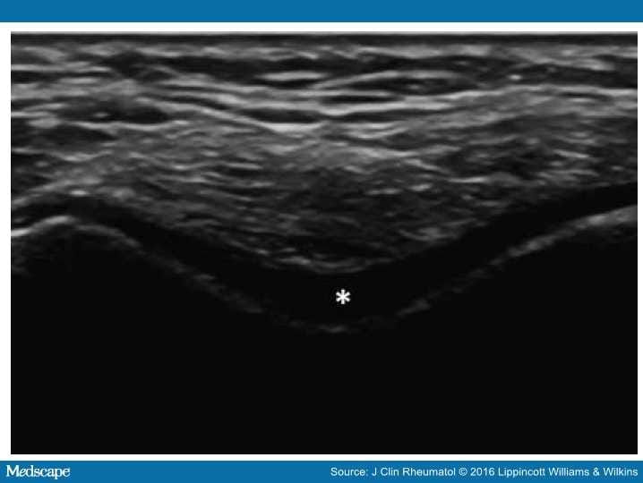 Role Of Ultrasonography In Knee Osteoarthritis