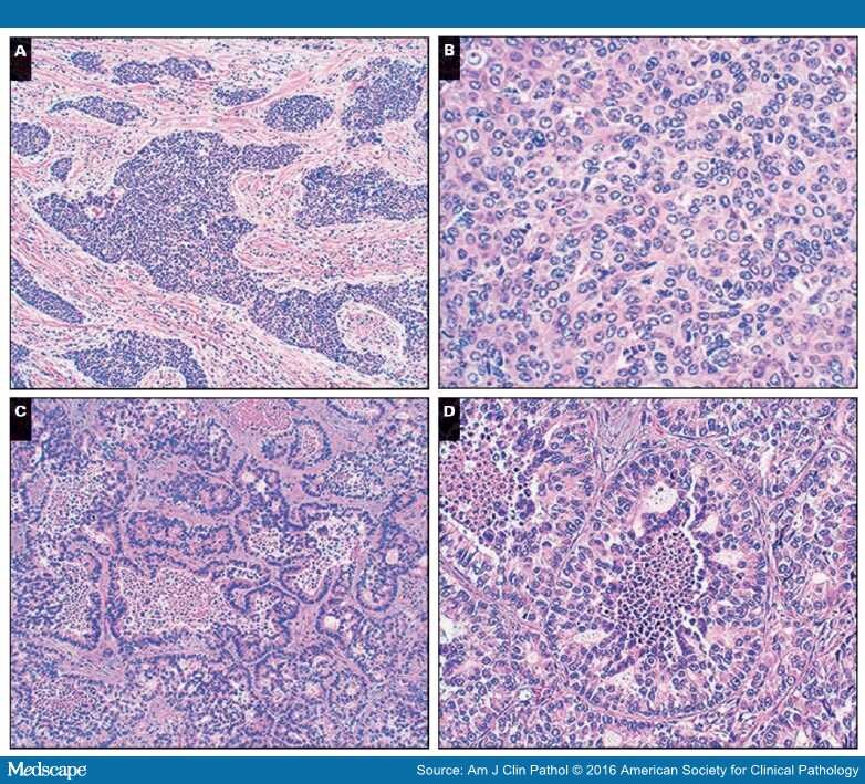 Neuroendocrine Differentiation in Thymic Carcinomas