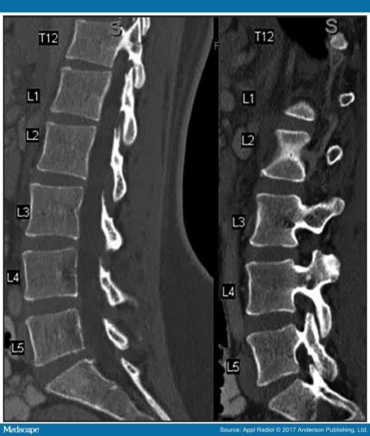 Retrolisthesis vs spondylolisthesis image