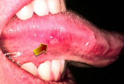 herpes under tongue