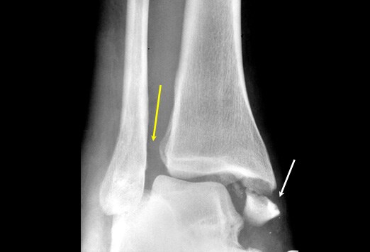 abriss processus styloideus ulnae therapie abriss processus styloideus ulnae therapie