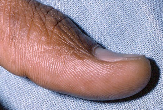 Veränderungen der Fingernägel: 15 Schlüssel zur richtigen Diagnose