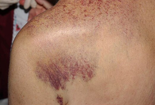 14 verschiedene Hautläsionen unter Chemotherapie Medscape