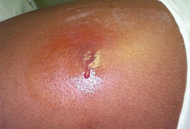 Ring Around Mosquito Bite Ring Around Mosquito Bite