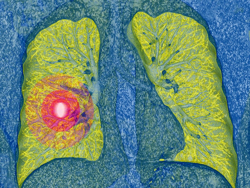 Was Ist Ein Pulmonaler Rundherd deutsch.medscape.com
