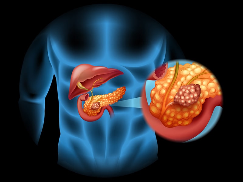 Pankreaskarzinom: Mit Enzymhemmung Gegen Therapieresistenz