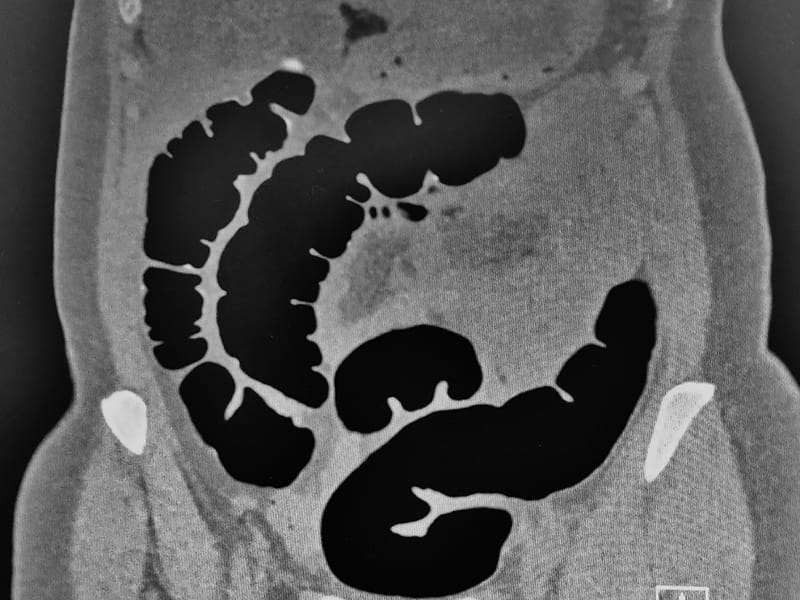 magengeschwür ct oder mrt