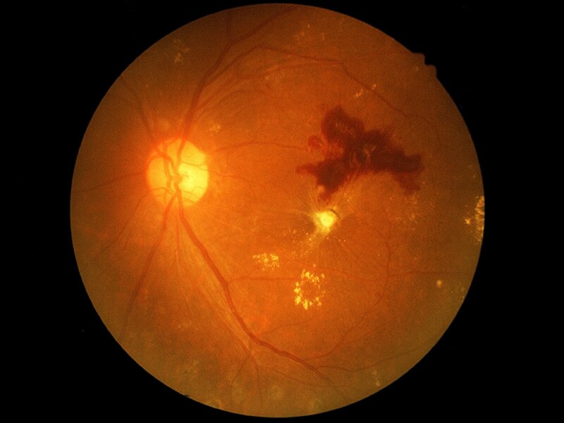 Deficiencias en el cribado de la retinopatía diabética en Deficiencias en el cribado de la retinopatía diabética en