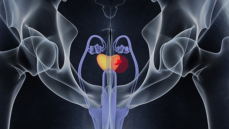 falla bioquímica cáncer próstata