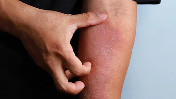 Consejos a pacientes sobre opciones de tratamiento de dermatitis atópica