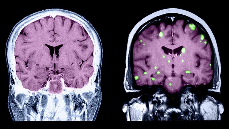 what-happens-when-breast-cancer-spreads-to-lymph-nodes