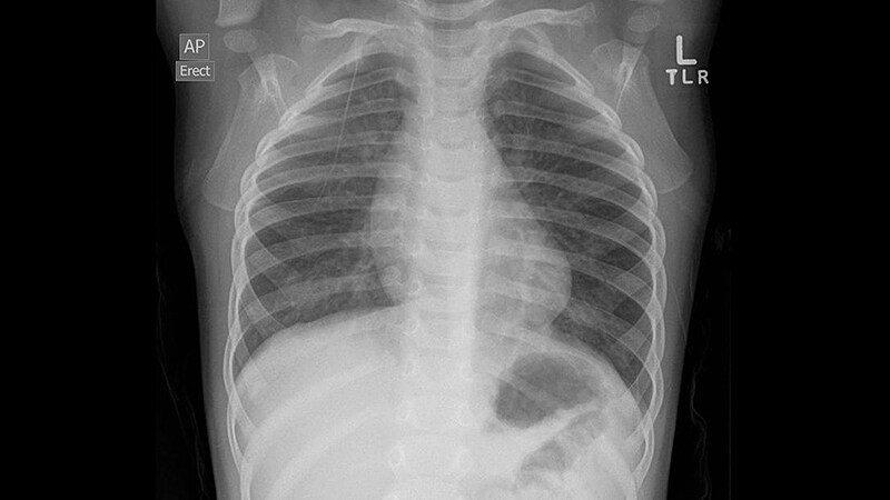 5 minutos de pediatría Lactante con dificultad respiratoria y tos