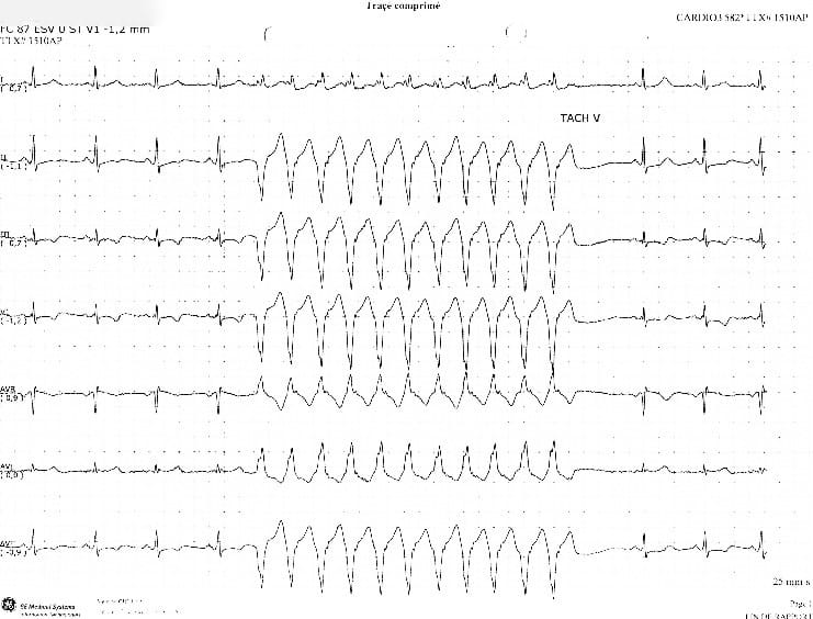Cas Clinique pisodes De Syncopes Chez Une Patiente g e cas-clinique-pisodes-de-syncopes-chez-une-patiente-g-e