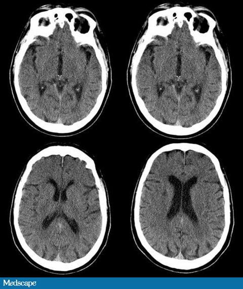 Agitation et hallucinations chez un homme âgé atteint de Agitation et hallucinations chez un homme âgé atteint de