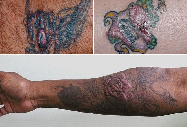 risques associ 233 s aux tatouages allergies infections et risques associ 233 s aux tatouages allergies infections et