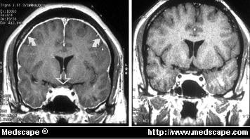 web md cerebrospinal fluid leak