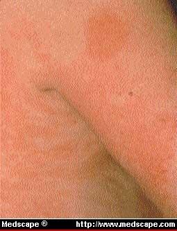 The layers of your skin | American Academy of Dermatology
