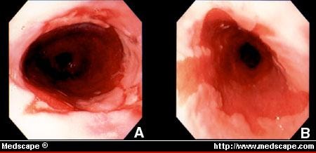 Barrett's Esophagus: Clinical Implications diagram of esophagus cancer 