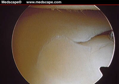 Meniscal Lesions: Diagnosis And Treatment