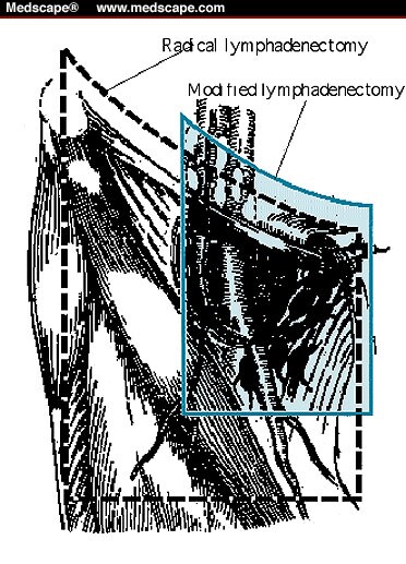 inguinal-lymph-node-dissection-for-penile-carcinoma