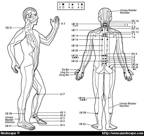 acupuncture-for-chronic-low-back-pain