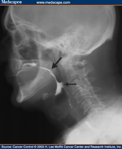 dysphagia swallow pharyngeal oropharyngeal aspiration