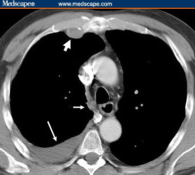 sorts of asbestos pdf