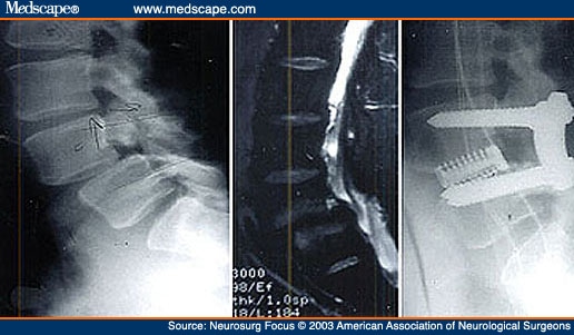 What exercises are safe for someone with spinal stenosis (L2, L3) spondylolisthesis and osteopenia?