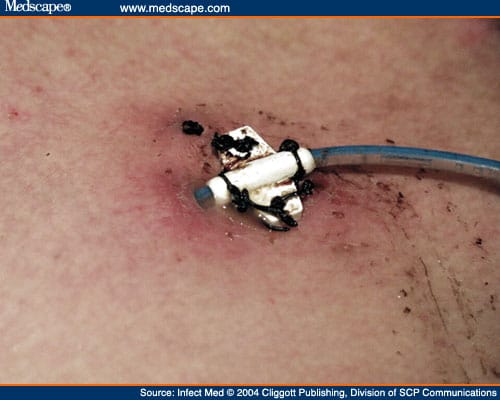 Dialysis Port infection