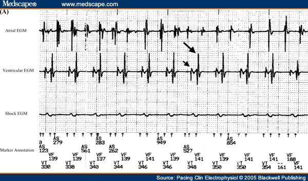 right atrial flutter icd 10