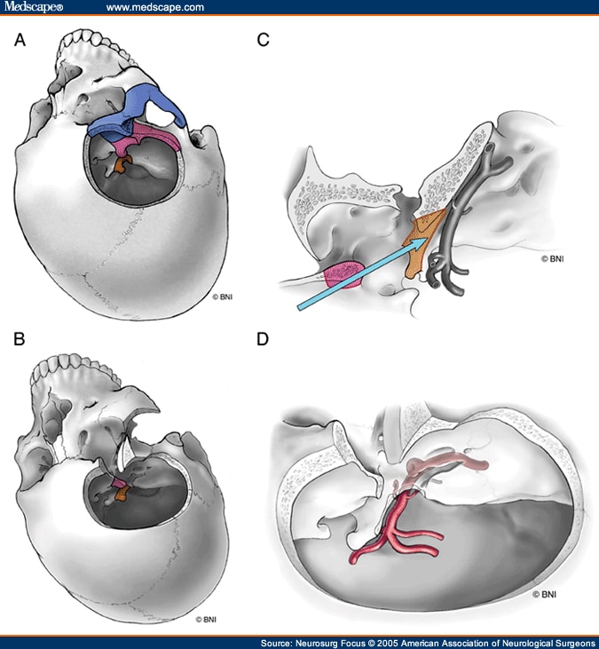 Skull Base Approaches To The Basilar Artery