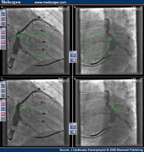 LV Lead Placement Within a Coronary Sinus Side Branch