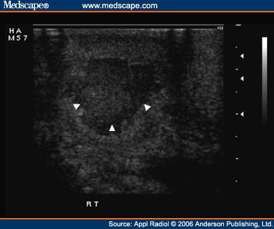 testicular sonogram