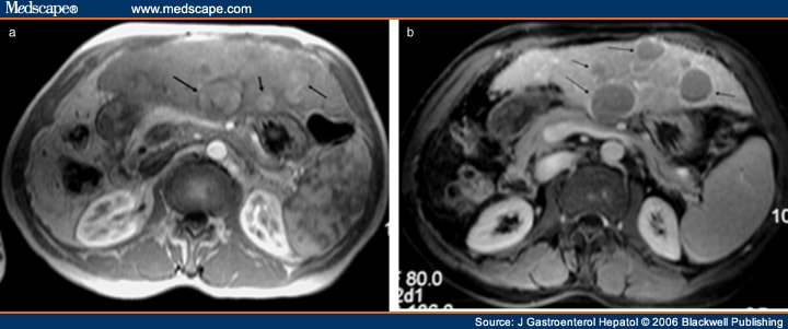 Review Magnetic Resonance Imaging Of The Liver How I Do It