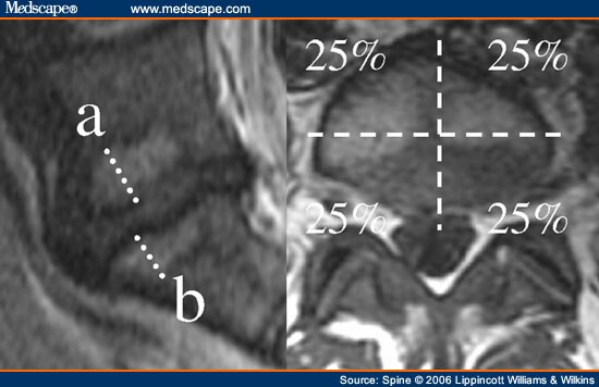 a-three-year-follow-up-of-lumbar-spine-endplate-modic-changes