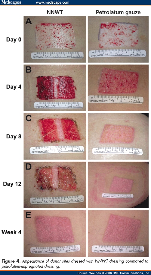 Low Profile Noncontact Normothermic Wound Dressing for Skin Graft