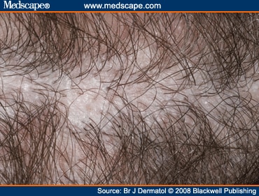 What is alopecia lichen planopilaris?