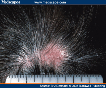 Management Of Primary Cicatricial Alopecias