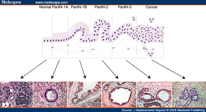 Improving Outcomes for Operable Pancreatic Cancer