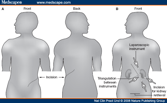 Laparoendoscopic Single-site Surgery In Urology