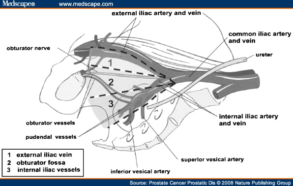 Pelvic Lymphadenectomy In Prostate Cancer