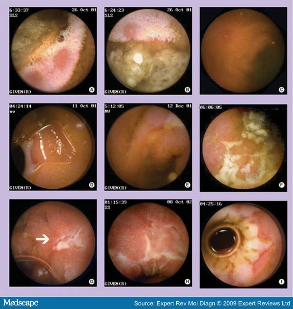 Capsule Endoscopy in the Evaluation and Management of IBD