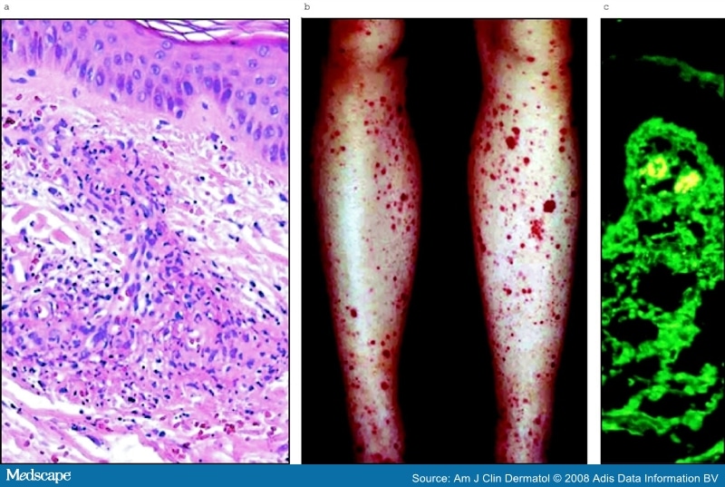 Clinical Approach To Cutaneous Vasculitis