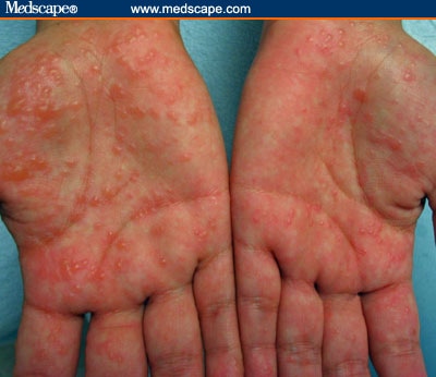 Papules And Bullae On The Palms And Soles Of A 34-year-old Woman