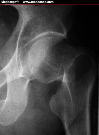 displaced right femoral neck fracture