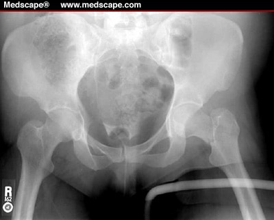 displaced right femoral neck fracture