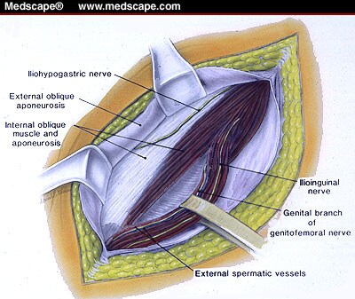 Surgery Roundtable: Current Issues in Inguinal Herniorrhaphy