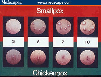 Medscape Personal Professor: Smallpox